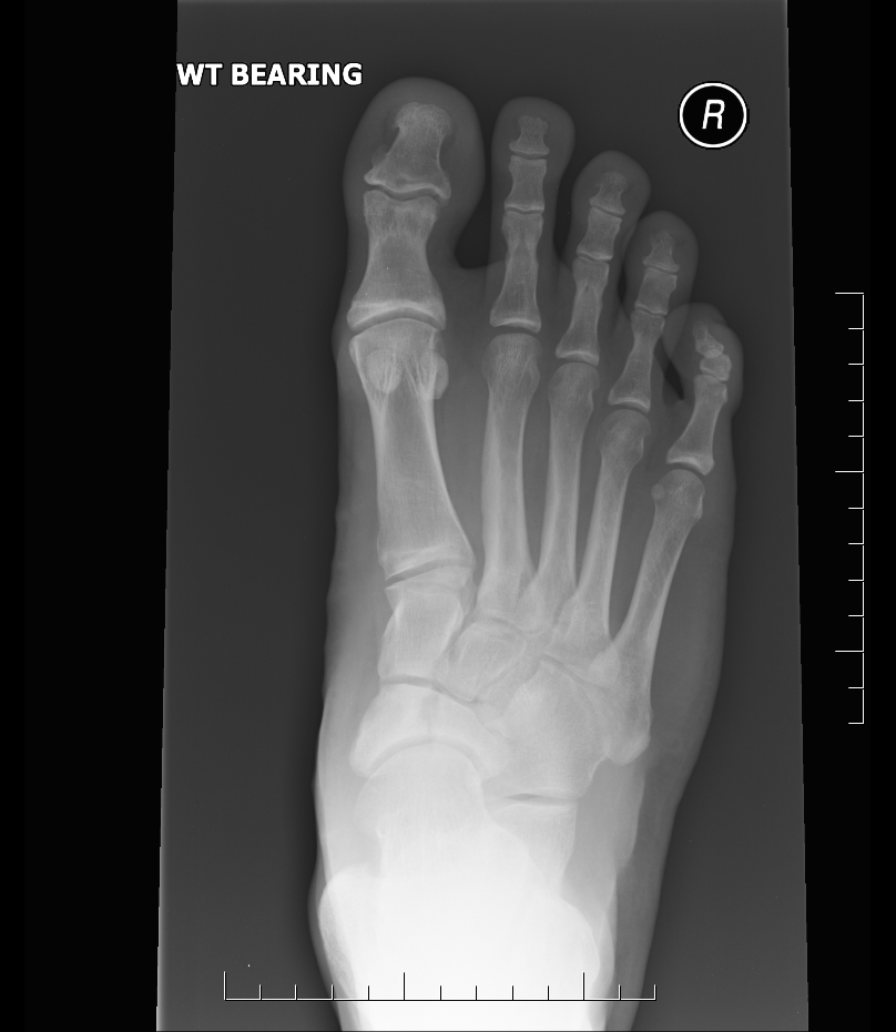 Navicular Fracture AP